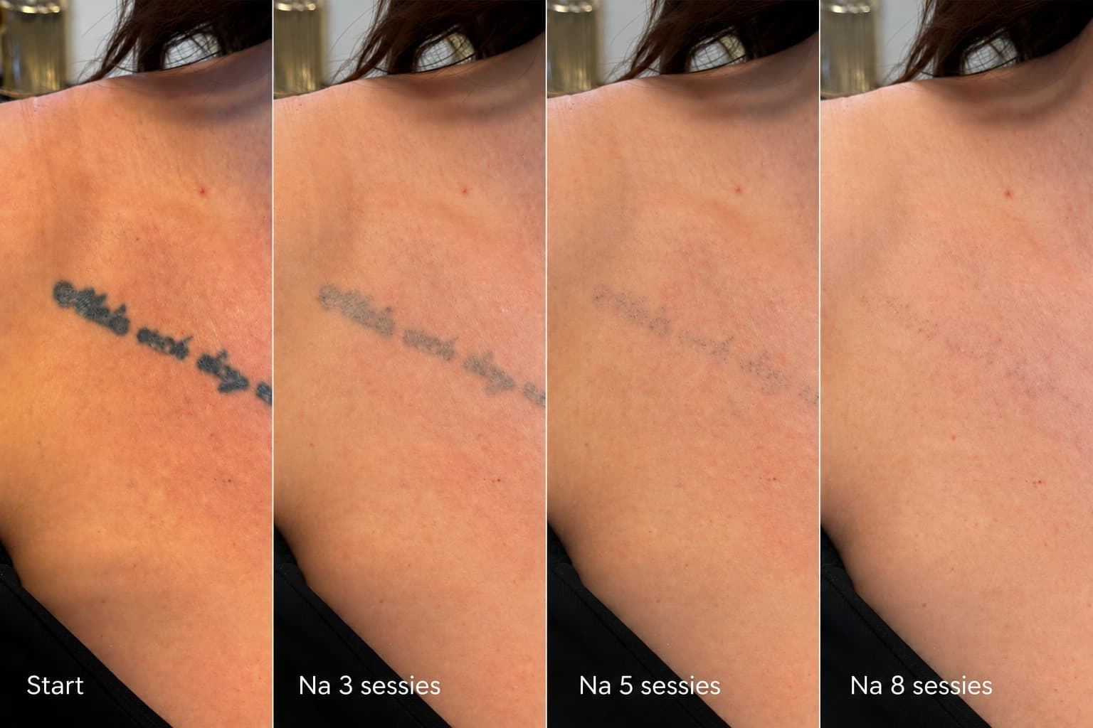Tattoo op het sleutelbeen bij de start en na 3, 5 en 8 laserbehandelingen bij Younique Salon in Maarssen